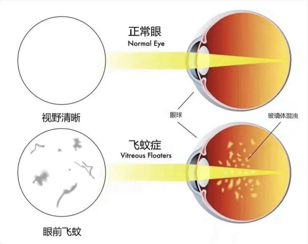 人眼玻璃体飞蚊症病变示意图