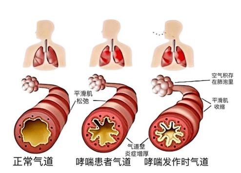 换季温差刺激哮喘患者气道原理示意图
