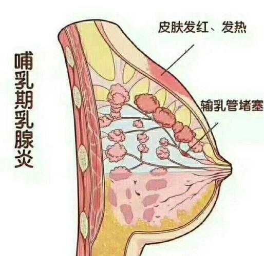 哺乳期乳腺炎早期症状对比示意图