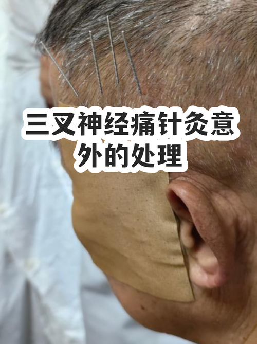 三叉神经痛患者冬季面部保暖实拍图