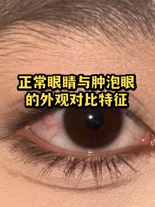 早晨起床后眼睑浮肿的饮水时间调整:老大夫的生活经验分享-仁者医