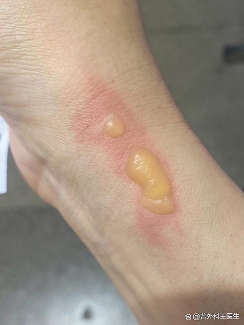 烫伤后错误使用牙膏导致起泡的皮肤示意图