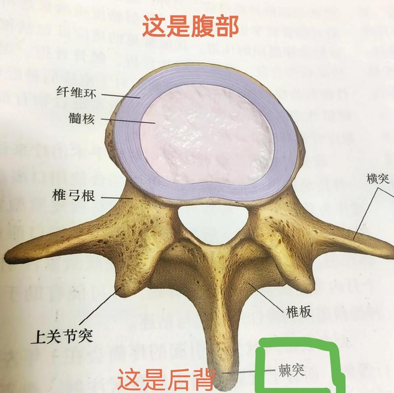 腰椎间盘突出结构侧面示意图