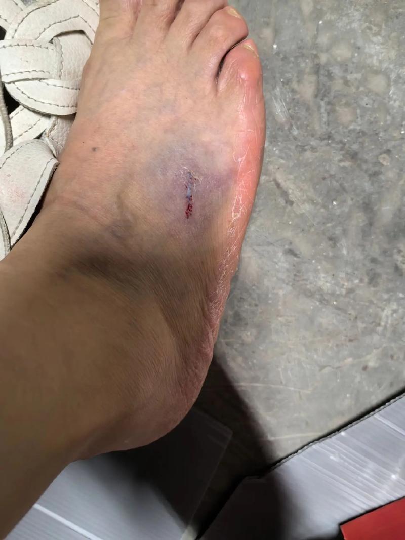 钢铁厂工人穿着不合规鞋子脚部被砸伤X光片