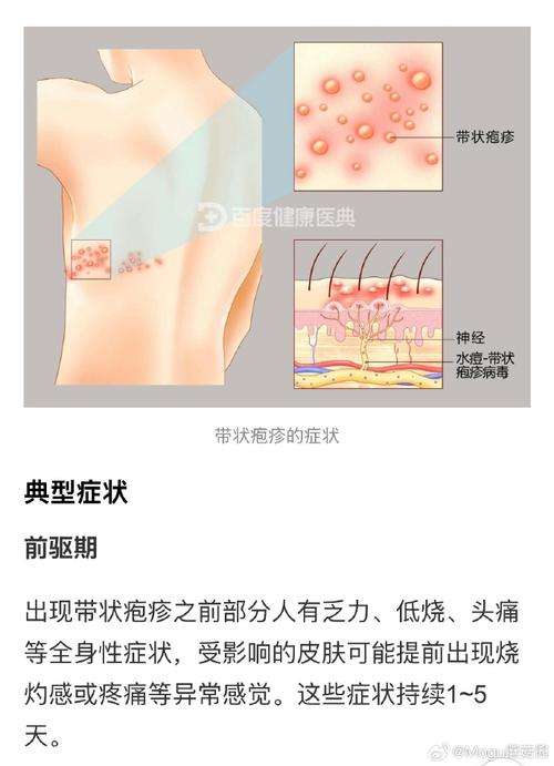 躯干带状疱疹皮疹神经分布示意图