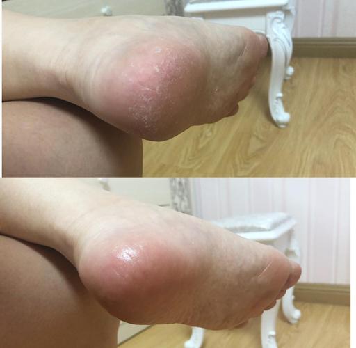 新鲜香蕉皮内侧护理干燥脚后跟实拍