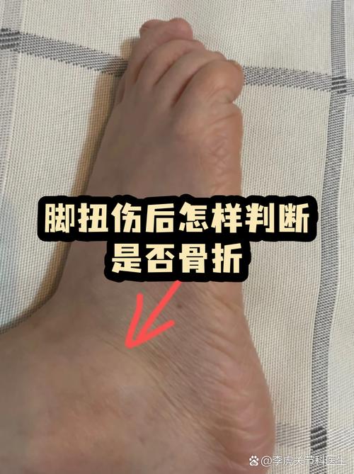 怎么判断是不是真的骨折了？