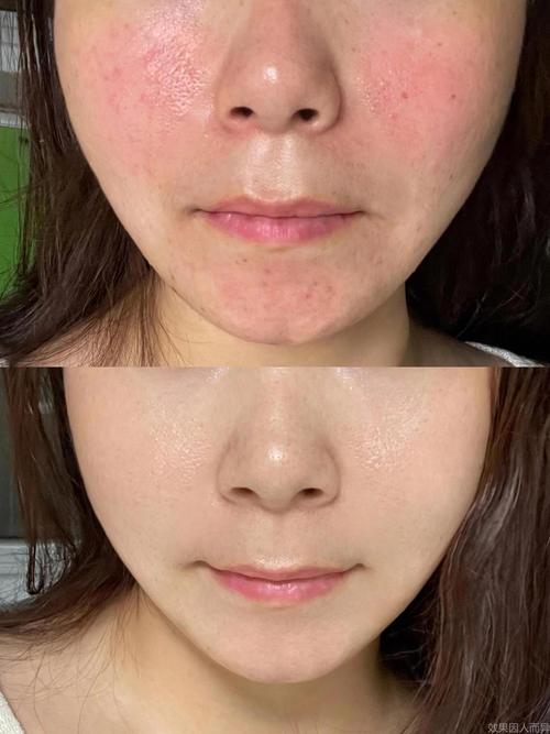 产后女性激素波动对皮肤影响对比图