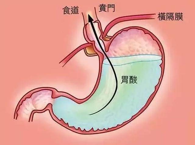 慢性胃炎胃酸分泌昼夜节律示意图