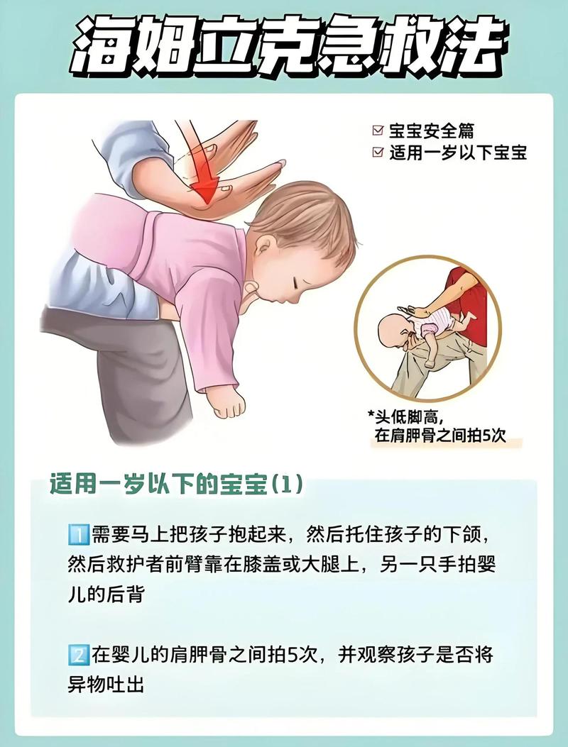 一岁婴儿异物呛咳海姆立克操作示意图