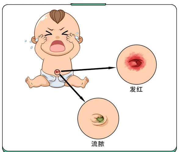 新生宝宝异常宝宝脐部症状对照图