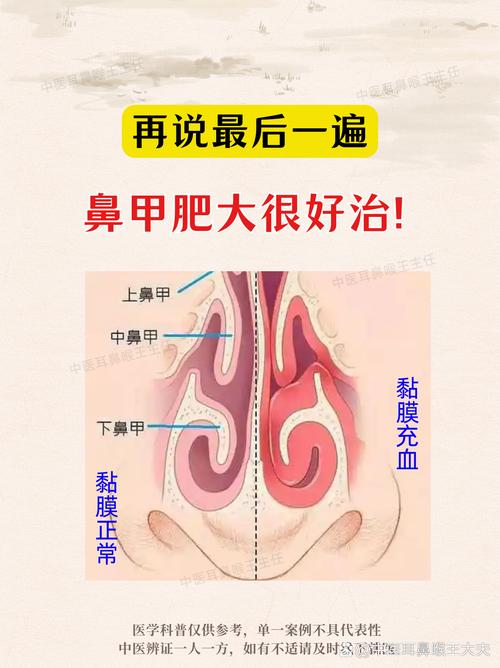感冒后鼻腔黏膜肿胀对比示意图
