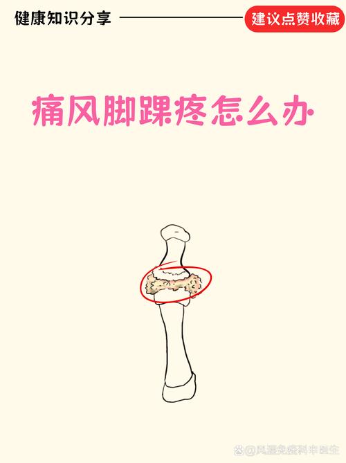 痛风急性期踝关节肿胀示意图