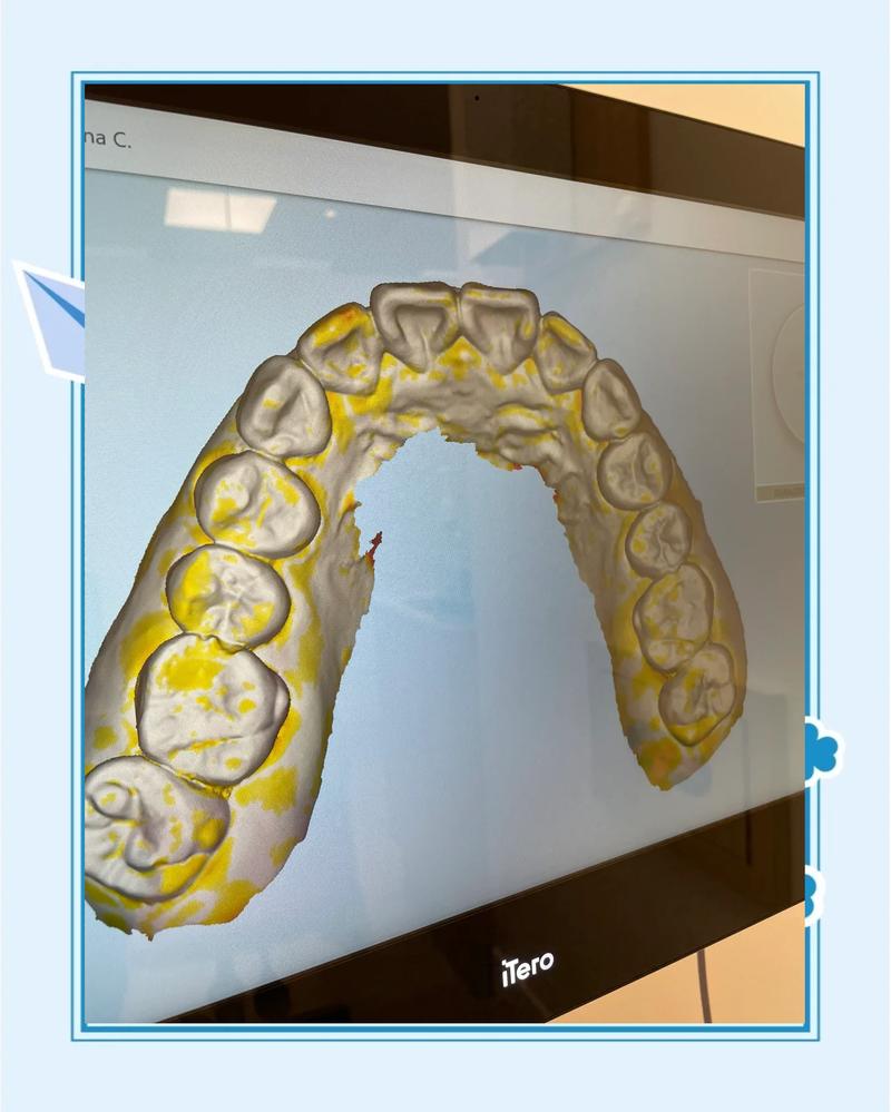 数字媒体技术生成的口腔正畸3D模拟效果图