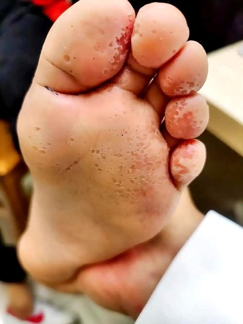 那些年我在足部护理上踩过的坑