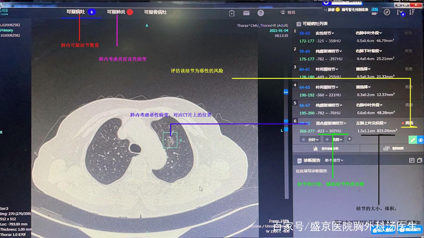 医疗AI肺结节诊断算法训练界面