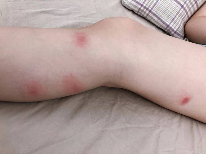 宝宝被蚊虫叮咬后红肿的腿部实拍