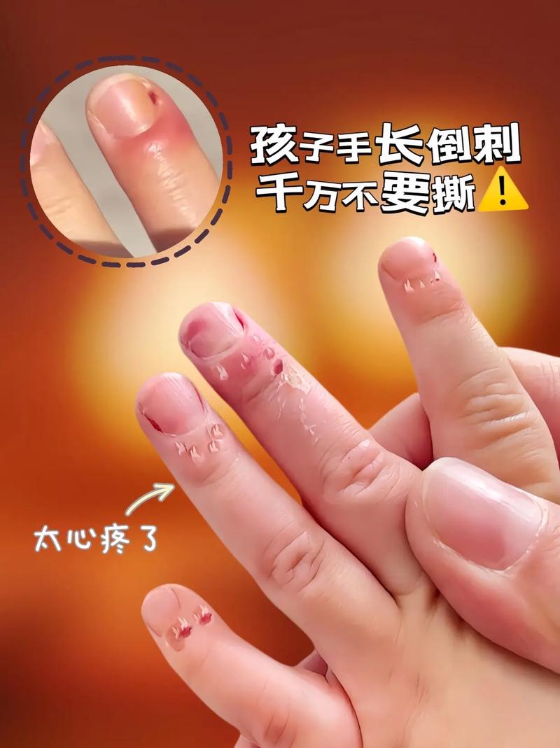 错误撕倒刺伤指甲示意图