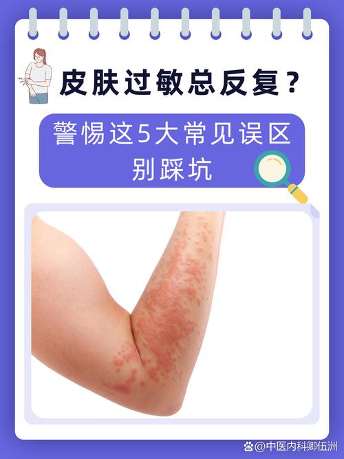 我踩过的坑:过敏刚发作的前72小时别乱做的事