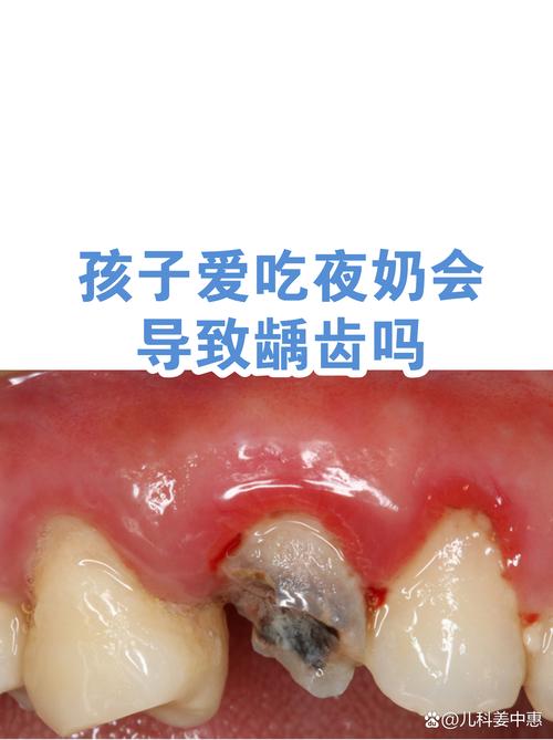 十个月宝宝频繁夜奶早期龋齿症状图