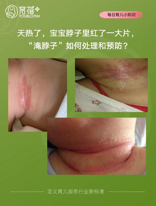 三个月宝宝脖子长热疹护理场景
