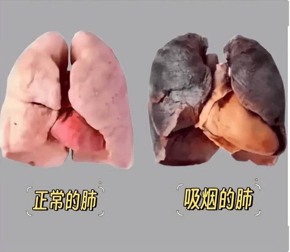 吸烟人群不同程度肺损伤对比示意图