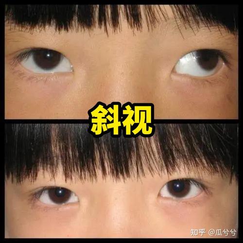 婴幼儿先天性斜视外观判断对比图