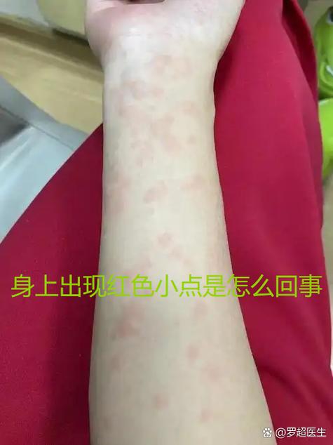 手臂接触猫毛后出现的连片红色风疹块特写