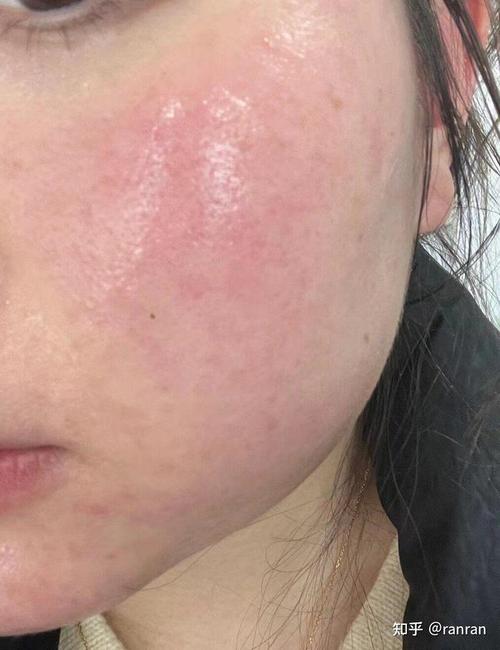 新娘敷面膜过敏脸红疹近照