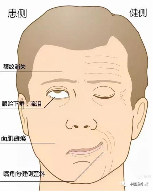 面神经炎患者闭眼留缝示意图