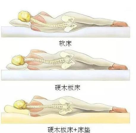 不同体重腰椎间盘突出人群床垫硬度参考
