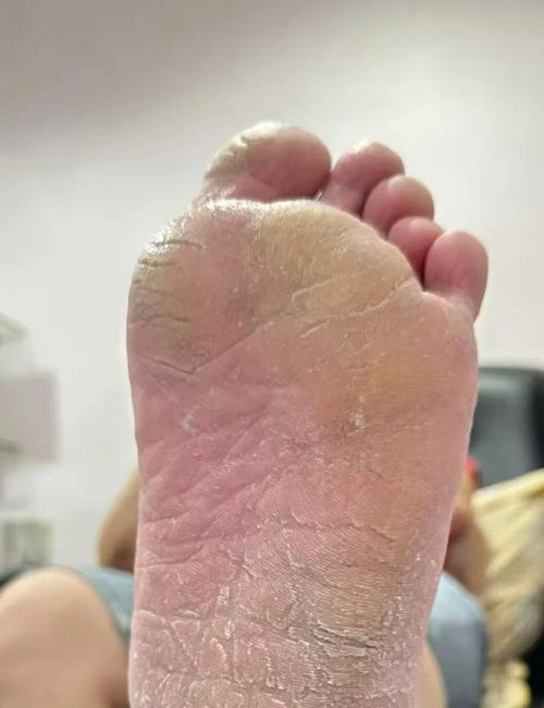健康足部皮肤与干裂足部皮肤对比图