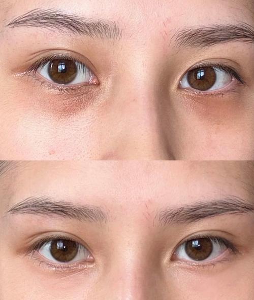 青少年睡眠不足引起的黑眼圈特写图
