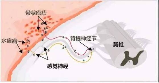 带状疱疹损伤神经髓鞘对比示意图
