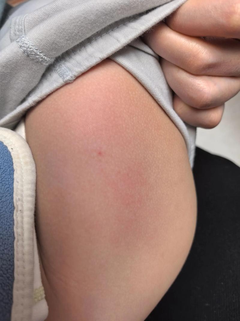 婴儿大腿部位疫苗注射后过敏红肿照片