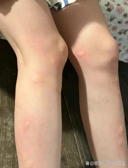 山林徒步后腿部被蚊虫叮咬的红肿包块