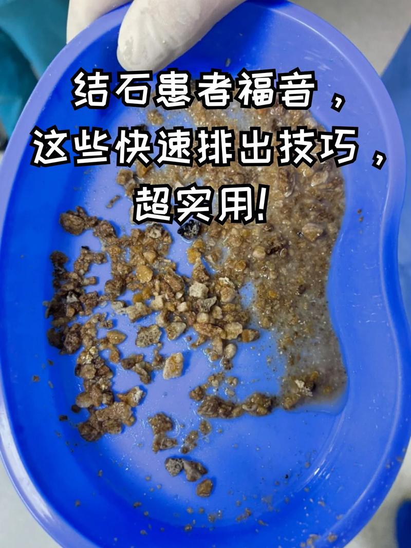 结石排出来就没事了？复发的坑大多主人都踩
