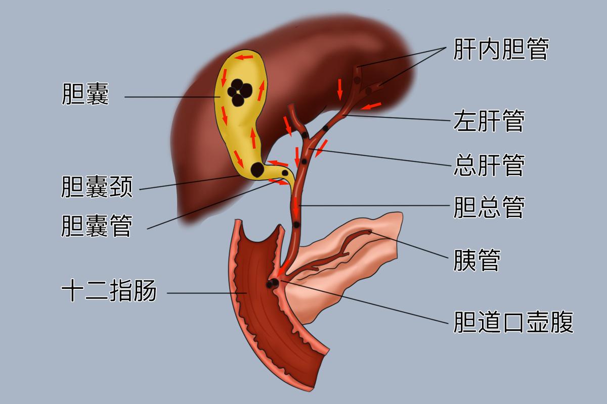 胆囊切除前后胆汁排泄路径对比示意图