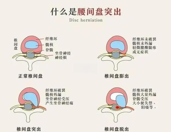 犬椎间盘突出早期与正常走路姿态对比图