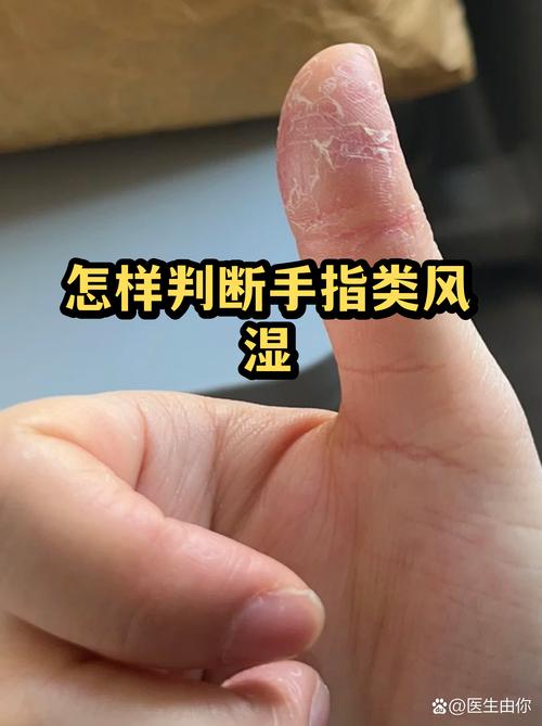 晨起关节发僵关节润滑原理示意图