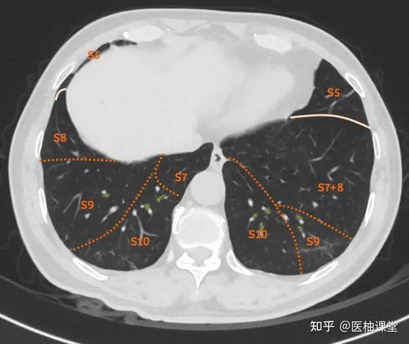 医生手动分割肺部CT病灶示意图