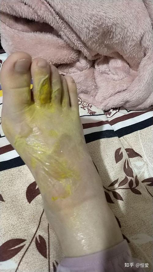 厨房烫伤 自来水冲洗 脚背 15分钟