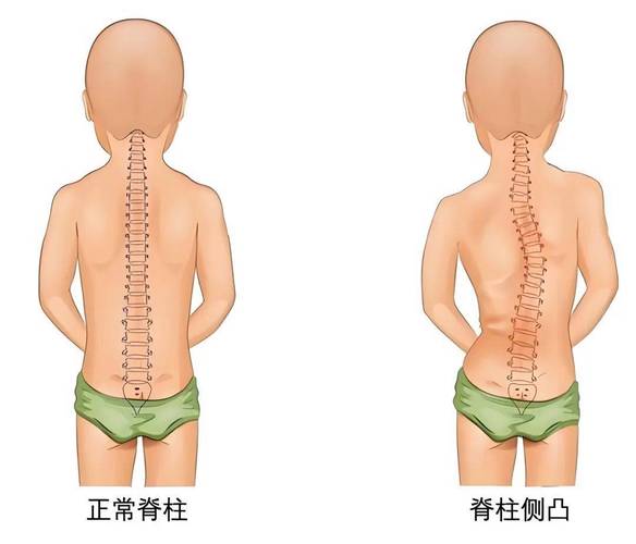 青少年弯腰脊柱筛查正面示意图