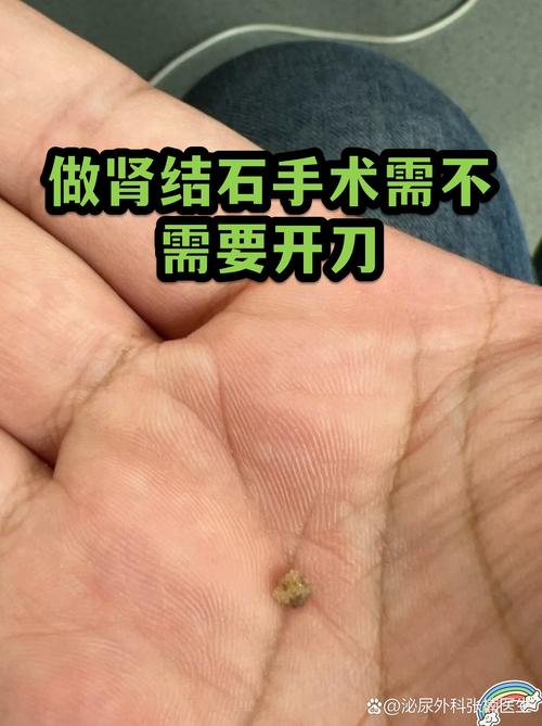 得了结石,一定要开刀做手术吗?