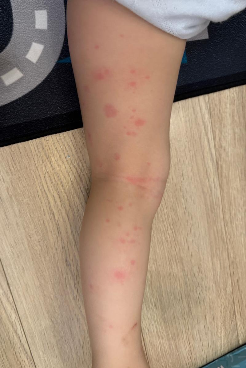 婴幼儿过敏初期症状对比图