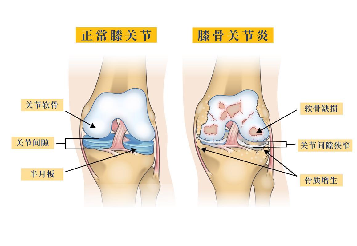 膝关节骨关节炎上下楼负重对比示意图