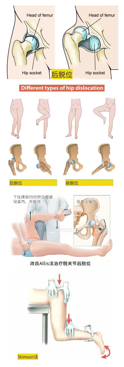 查出脱位之后，到底该怎么办？