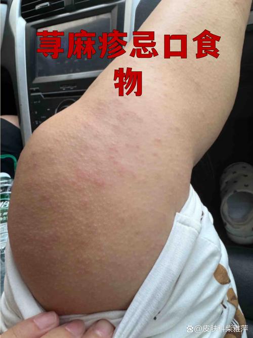 手写慢性荨麻疹饮食日记示例图