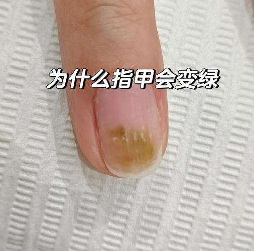 美甲后指甲变绿真菌感染迹象
