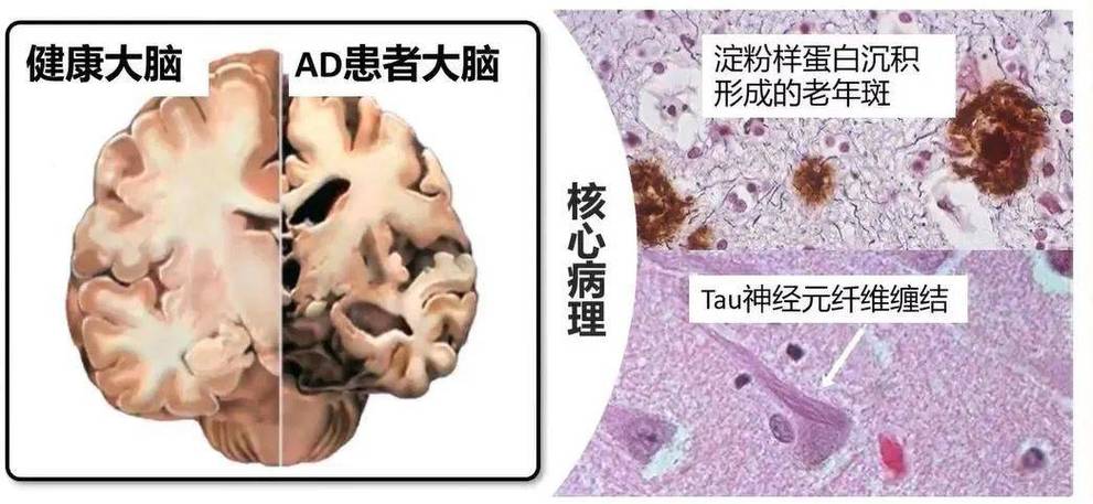 阿尔茨海默病患者大脑β-淀粉样蛋白斑块扫描图